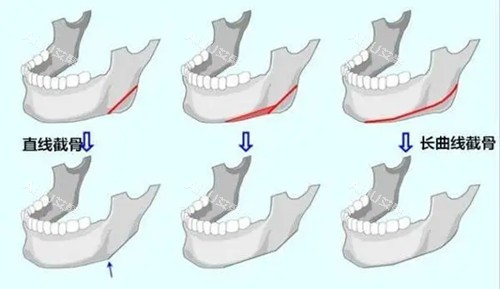 下颌骨截骨整形卡通示意图