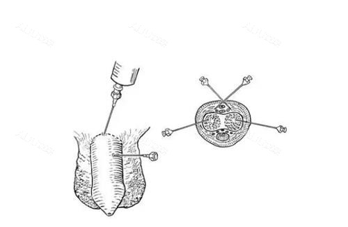 海绵体注射示意图