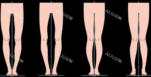 不同腿型卡通示意图
