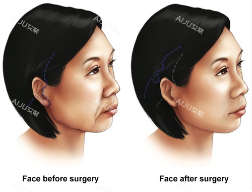 韧带提升面部提升手术前后对比图
