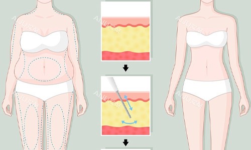 全身吸脂展示图