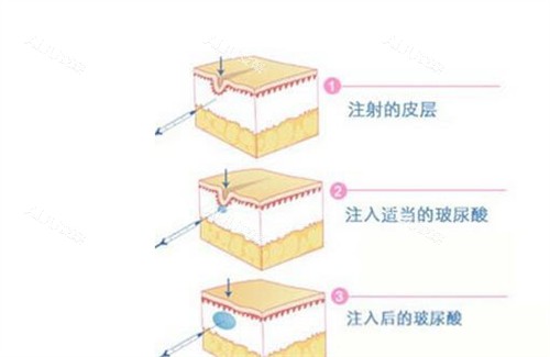 玻尿酸填充原理动画演示图