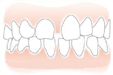 正畸后牙缝示意图