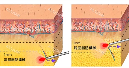 激光溶脂作用皮肤层图