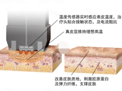 钻石超塑整形原理示意图