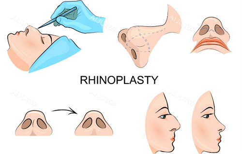 隆鼻过程图示