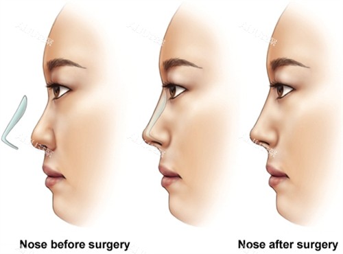 假体隆鼻手术前后对比