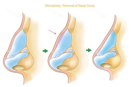 鼻部整形过程图