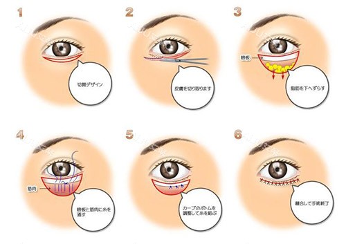 眼睑下至手术方法