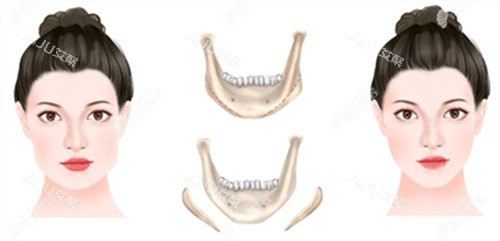 下颌骨截取手术前后对比图