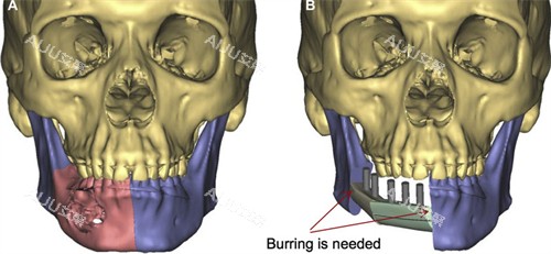 修复下颌骨