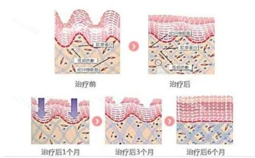 热拉提的治疗成效