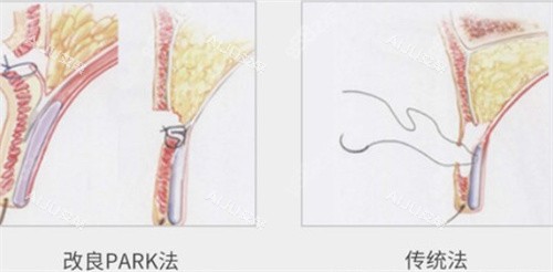 park双眼皮和传统对比