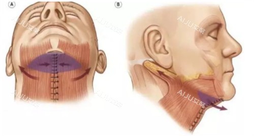颈阔肌成形术过程
