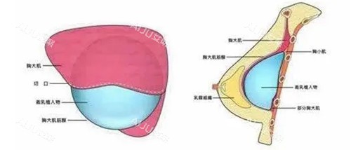 假体隆胸胸部切口卡通示意图