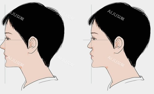 鼻基底填充前后对比卡通示意图