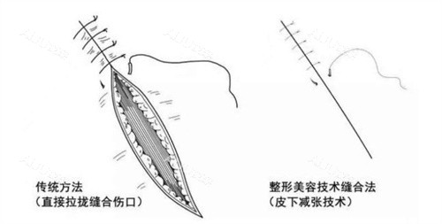 减张缝合手术