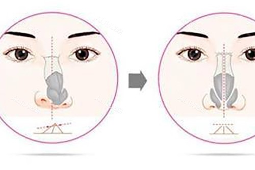 鼻矫正示意图