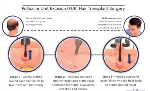 FUE手术过程