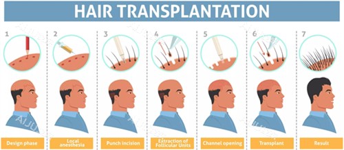 头发种植过程图