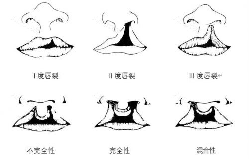 唇腭裂图片)