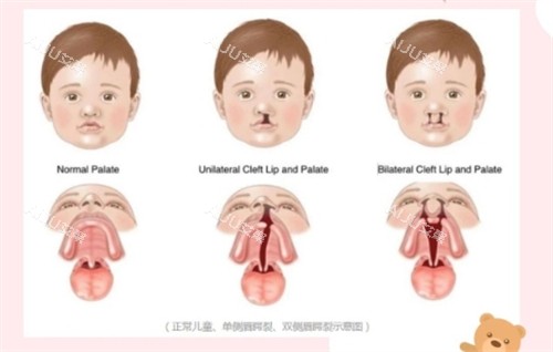 唇腭裂不同程度