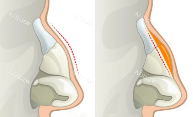 驼峰鼻矫正术鼻部对比