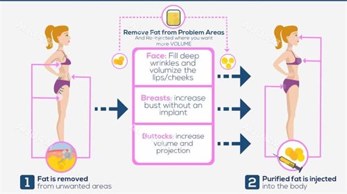 自体脂肪用来丰胸丰臀