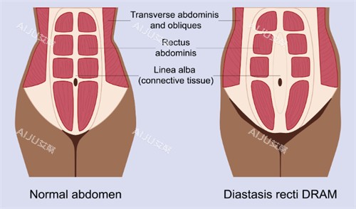 腹壁成形改善肌肉